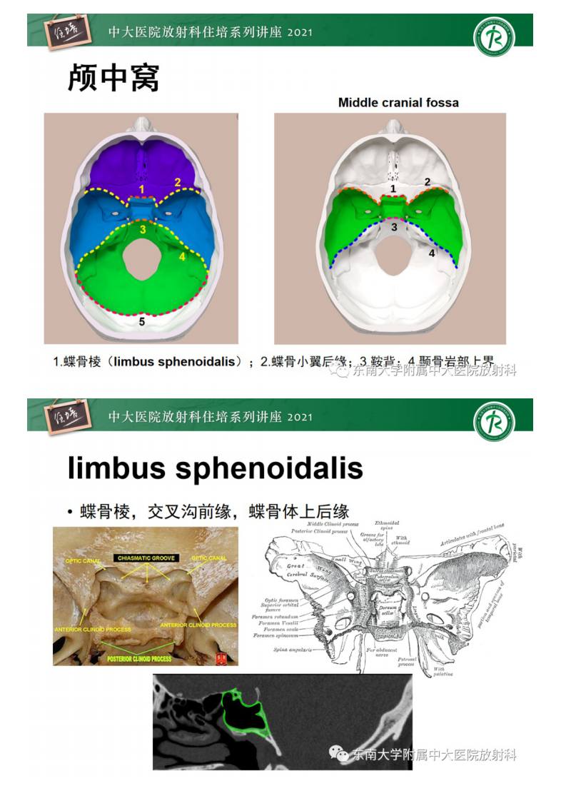 20210328_1【中大放射住培系列讲座】中颅窝底解剖结构及常见骨折征象.pdf 第2页
