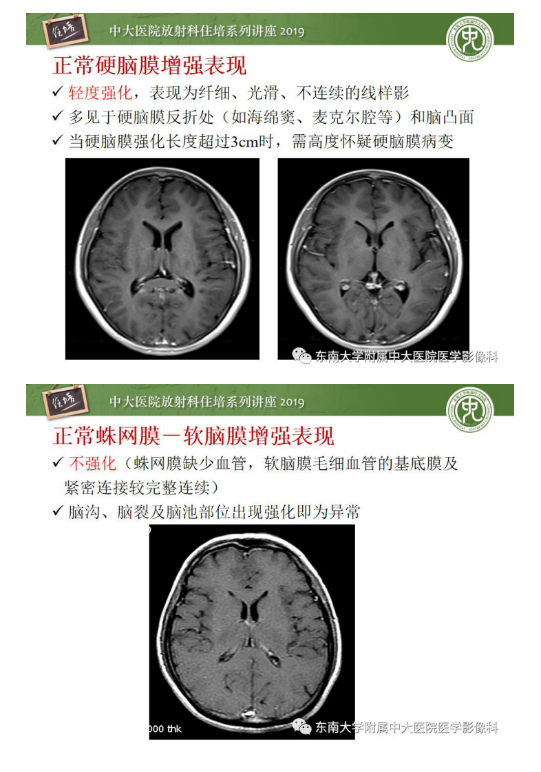 20190707_1【中大放射住培系列讲座第67期】脑膜异常强化及相关病变影像表现.pdf 第4页