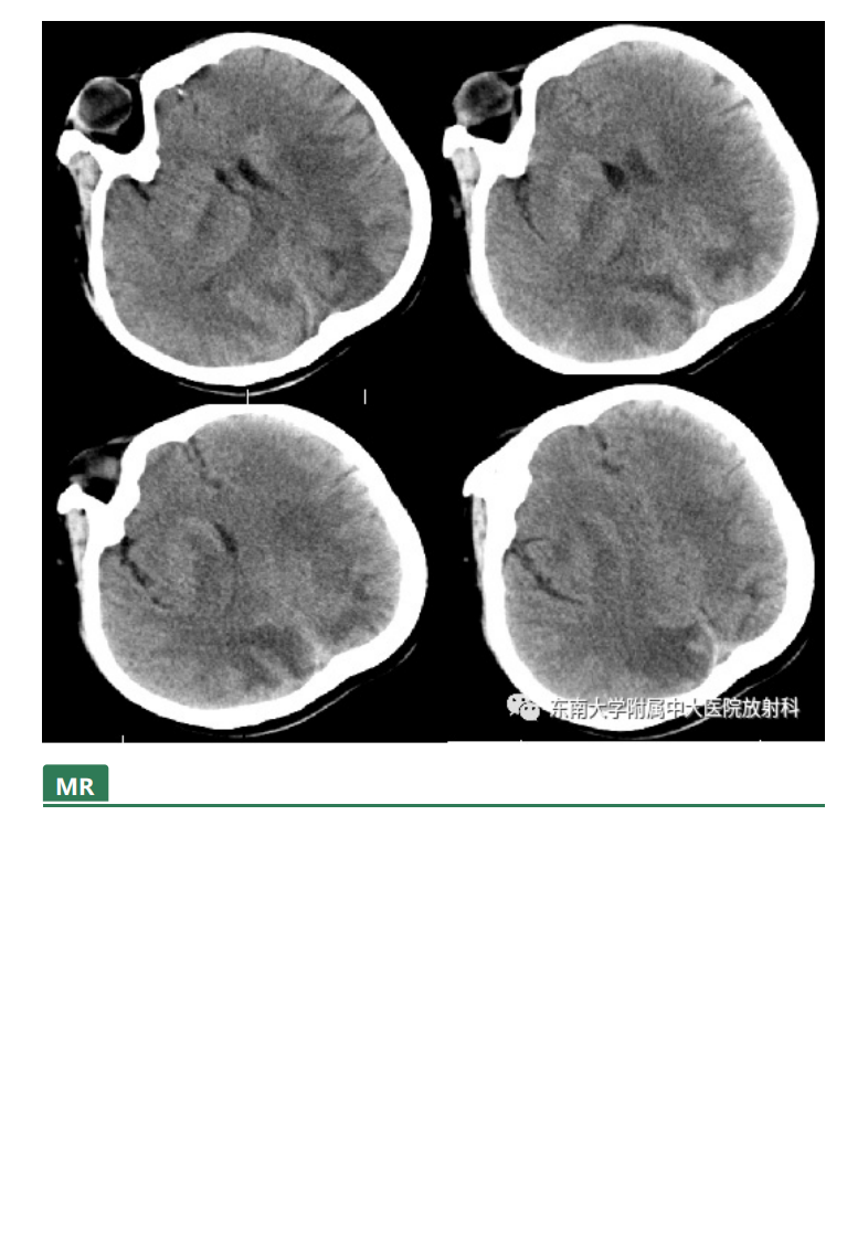 20210415_2【晨读结果公布】2021.04.14神经系统疾病——可逆性后部脑病综合征（PRES）.pdf 第2页