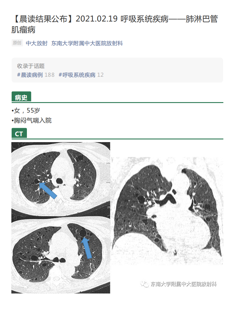 20210219_2【晨读结果公布】2021.02.19呼吸系统疾病——肺淋巴管肌瘤病.pdf 第1页