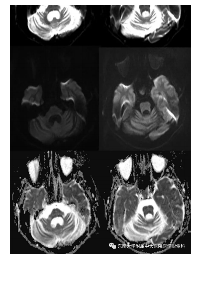 20200928_2【晨读结果公布】2020.09.28神经系统疾病——脊髓小脑性共济失调（病例1）.pdf 第3页