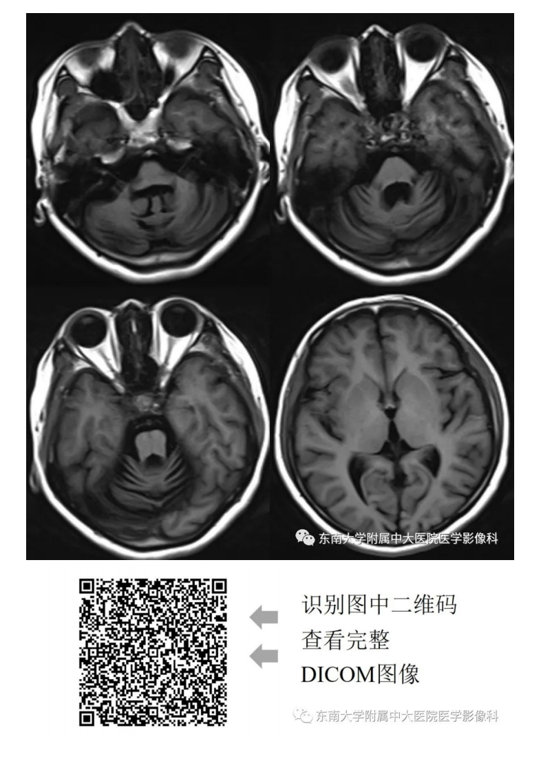 20200928_2【晨读结果公布】2020.09.28神经系统疾病——脊髓小脑性共济失调（病例1）.pdf 第5页