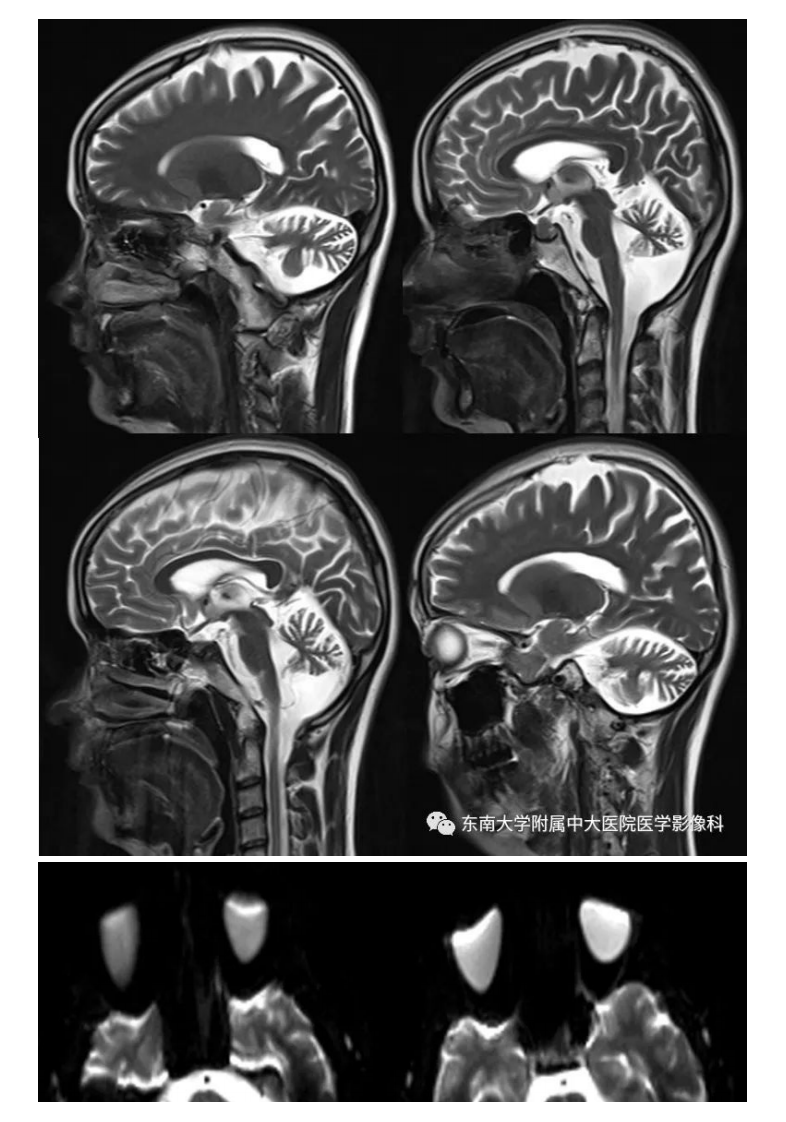 20200928_2【晨读结果公布】2020.09.28神经系统疾病——脊髓小脑性共济失调（病例1）.pdf 第2页