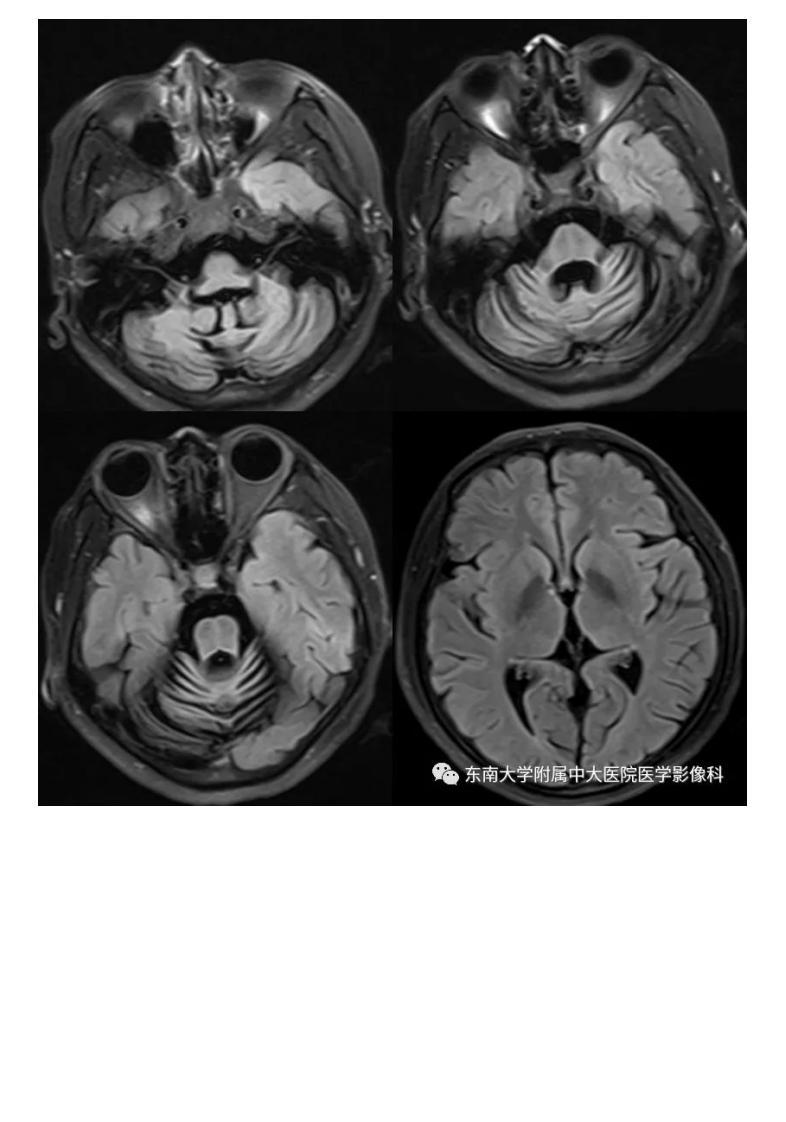 20200928_2【晨读结果公布】2020.09.28神经系统疾病——脊髓小脑性共济失调（病例1）.pdf 第4页