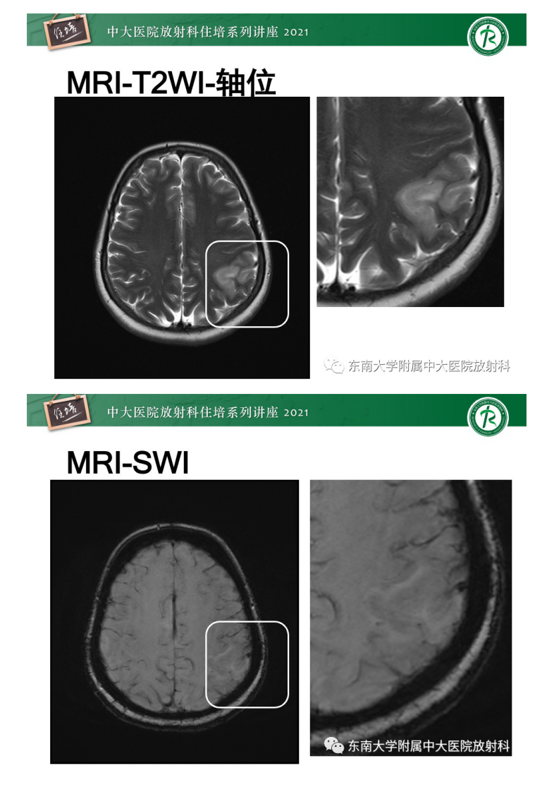 20210506_1【中大放射住培系列讲座】静脉性脑梗死的诊断思路.pdf 第3页