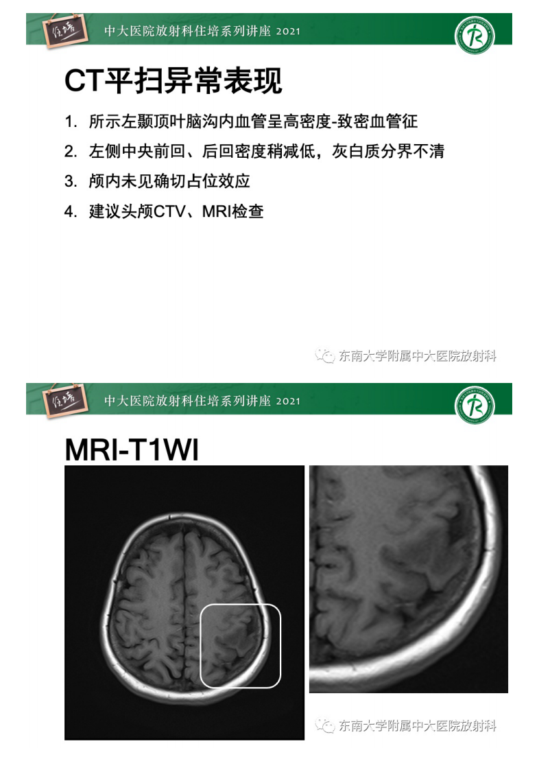20210506_1【中大放射住培系列讲座】静脉性脑梗死的诊断思路.pdf 第2页