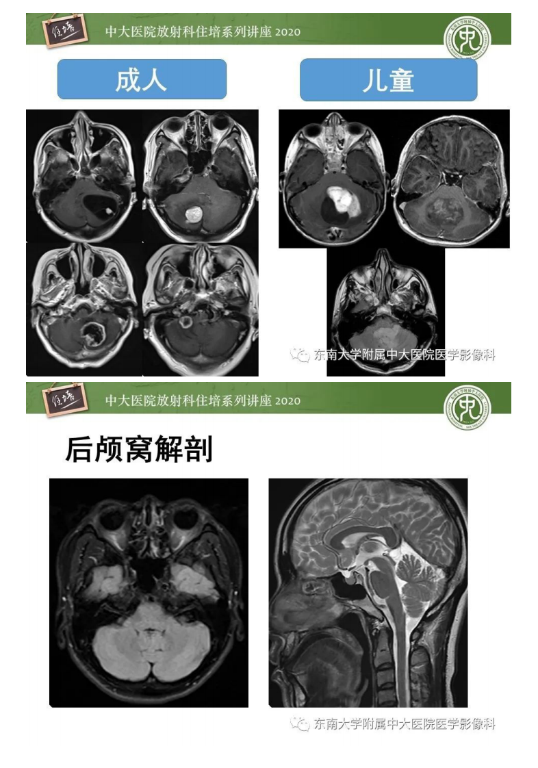 20200510_1【中大放射住培系列讲座】小脑占位的影像分析思路.pdf 第2页