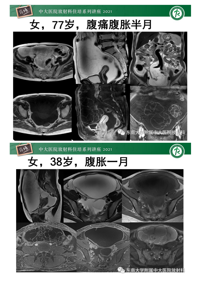 20210405_1【中大放射住培系列讲座】卵巢原发及继发粘液性肿瘤分析思路.pdf 第2页