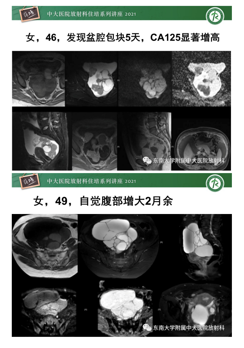 20210405_1【中大放射住培系列讲座】卵巢原发及继发粘液性肿瘤分析思路.pdf 第4页