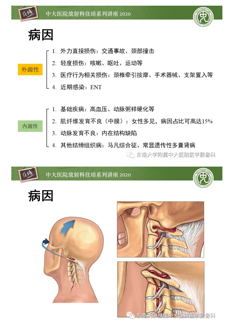 20200419_1【中大放射住培系列讲座】颈动脉夹层及夹层动脉瘤的影像诊断及评估.pdf 第5页