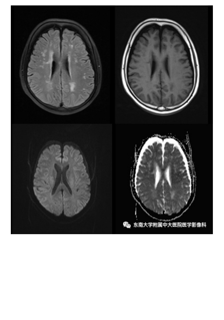 20201216_2【晨读结果公布】2020.12.15神经系统疾病——脑卒中模拟病.pdf 第2页