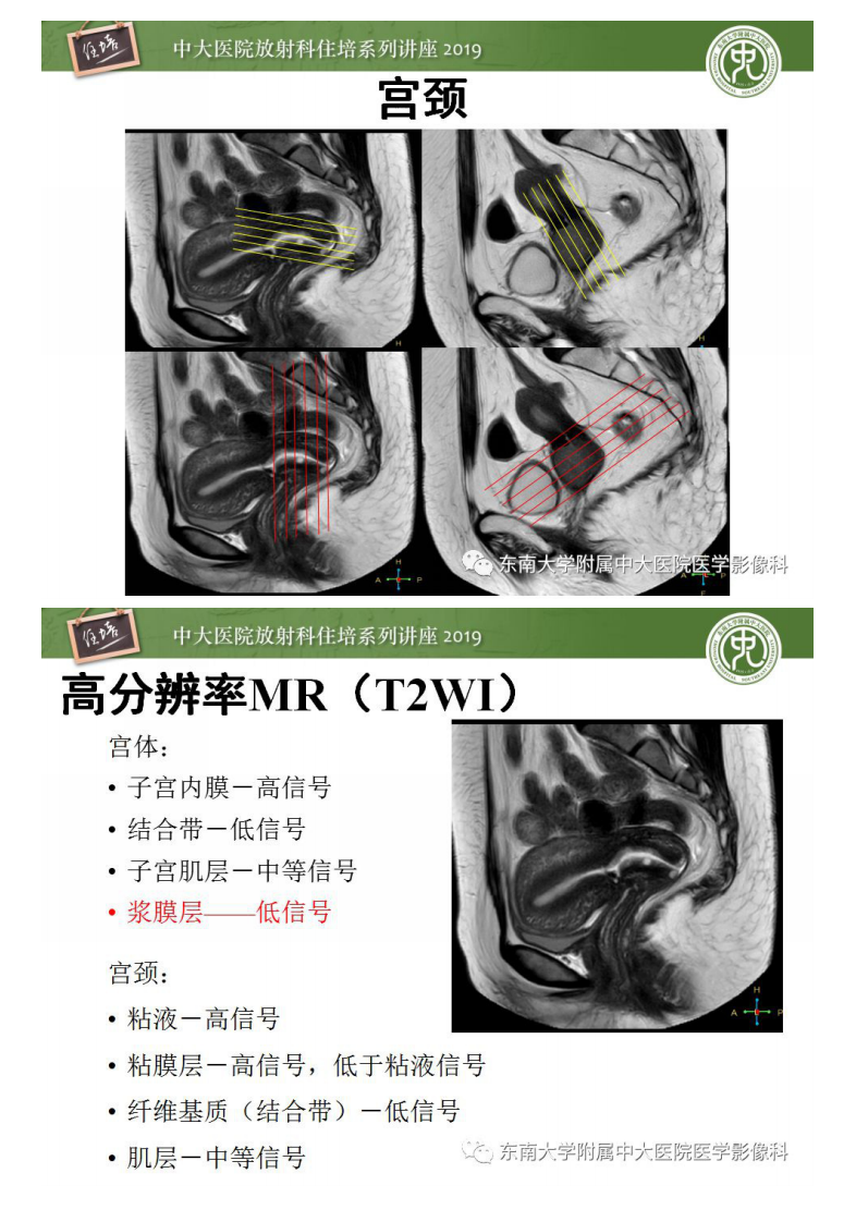 20190303_1【中大放射住培系列讲座第51期】子宫影像解剖及相关MR信号分析.pdf 第4页