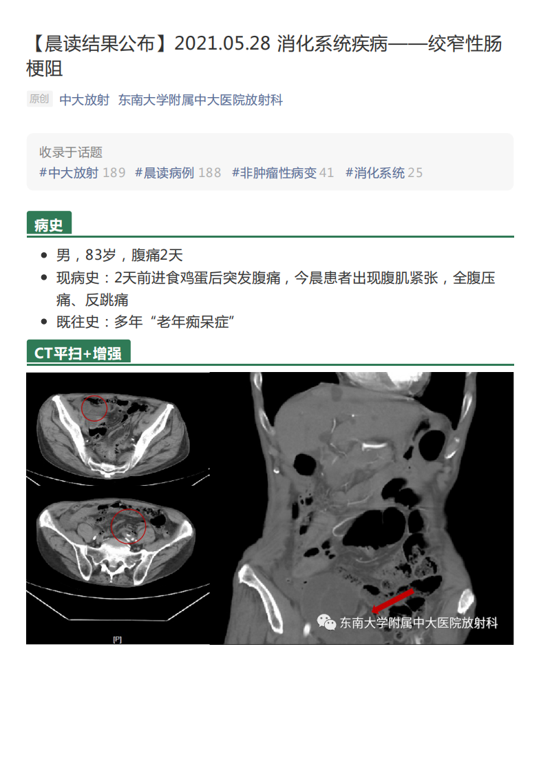 20210530_2【晨读结果公布】2021.05.28消化系统疾病——绞窄性肠梗阻.pdf 第1页