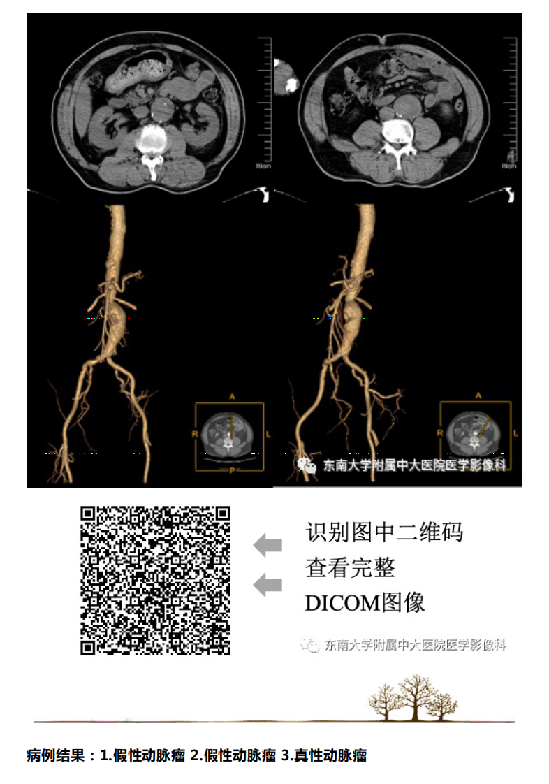 20201218_2【晨读结果公布】2020.12.17循环系统疾病——“真假”动脉瘤.pdf 第4页