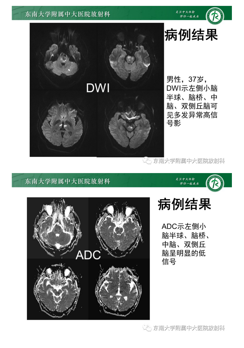 20210509_3【晨读结果公布】2021.05.08神经系统疾病——基底动脉尖综合征.pdf 第5页
