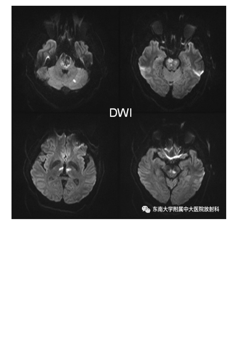 20210509_3【晨读结果公布】2021.05.08神经系统疾病——基底动脉尖综合征.pdf 第2页