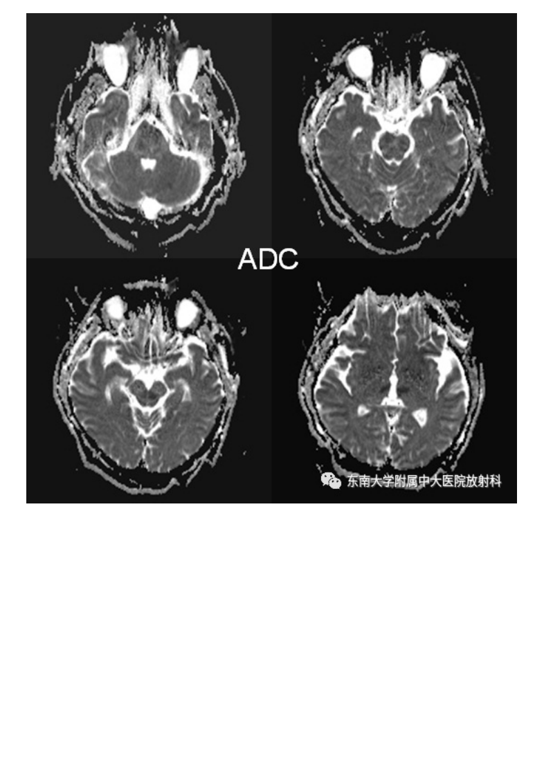 20210509_3【晨读结果公布】2021.05.08神经系统疾病——基底动脉尖综合征.pdf 第3页