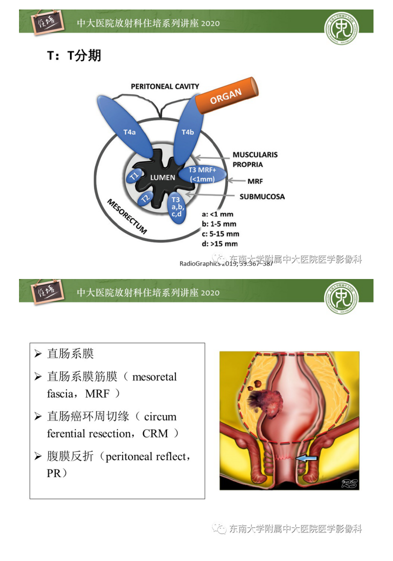 20210103_1【中大放射住培系列讲座】直肠癌影像临床分期注意事项.pdf 第5页