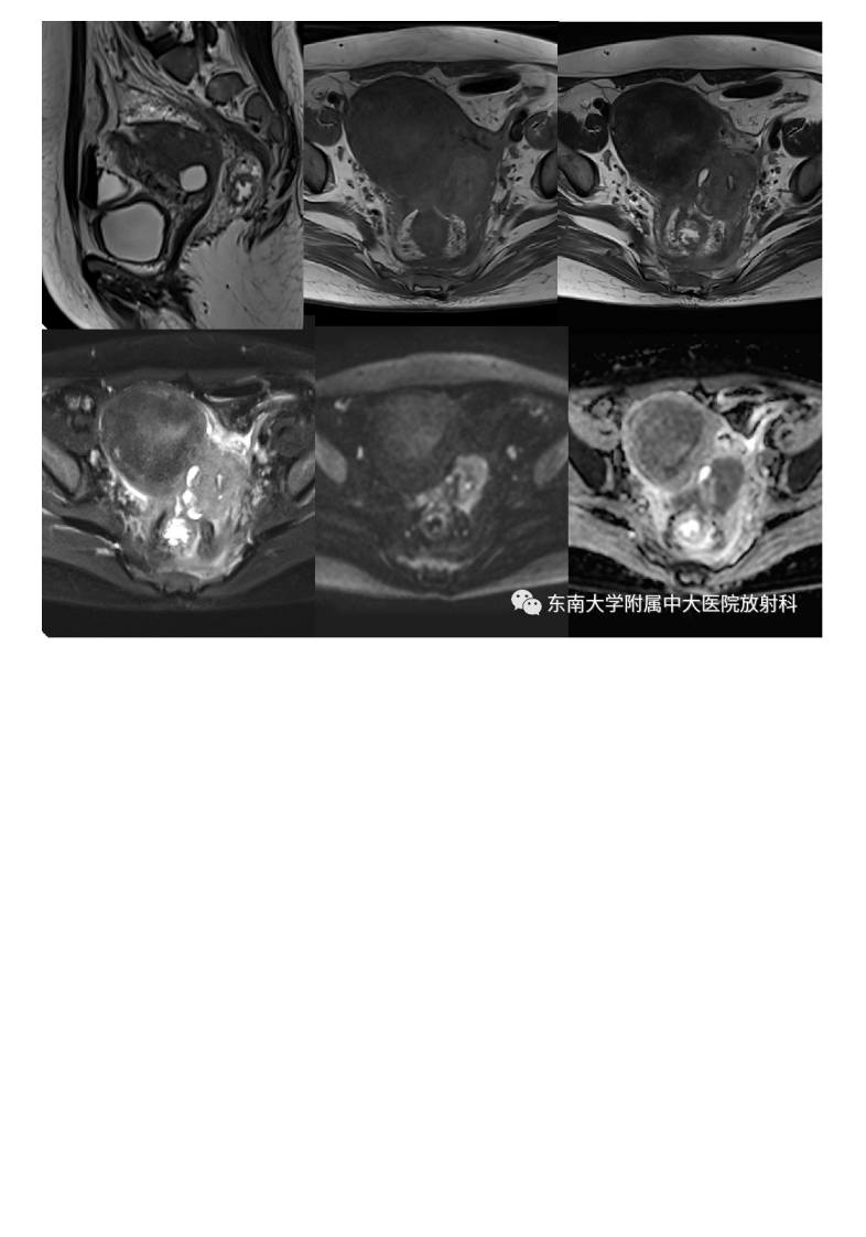 20210525_2【晨读结果公布】2021.05.24生殖系统疾病——病例1病理倾向于炎性假瘤；病例2：子宫内膜样癌；病例3：宫颈富细胞性肌瘤.pdf 第2页