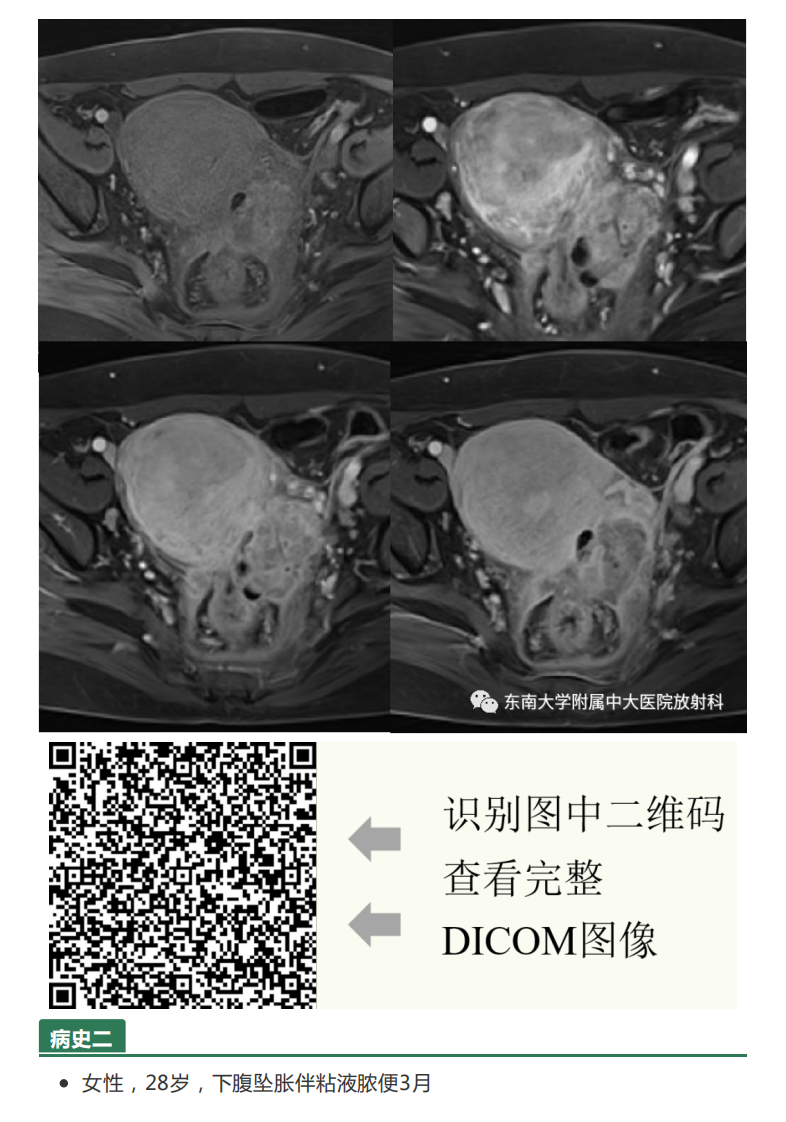 20210525_2【晨读结果公布】2021.05.24生殖系统疾病——病例1病理倾向于炎性假瘤；病例2：子宫内膜样癌；病例3：宫颈富细胞性肌瘤.pdf 第3页