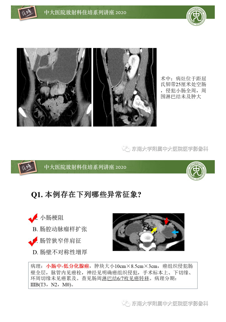 20200627_1【中大放射住培系列讲座】小肠恶性肿瘤的影像诊断思路.pdf 第4页