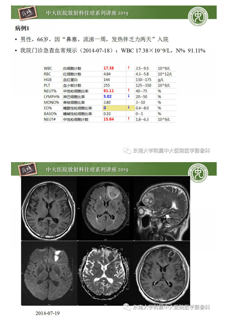 20190415_1【中大放射住培系列讲座第57期】脑脓肿的诊断与鉴别.pdf 第2页