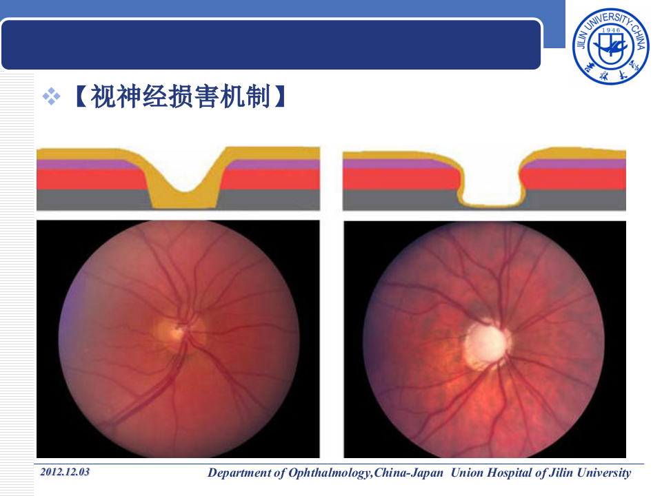 9)青光眼.ppt 第4页