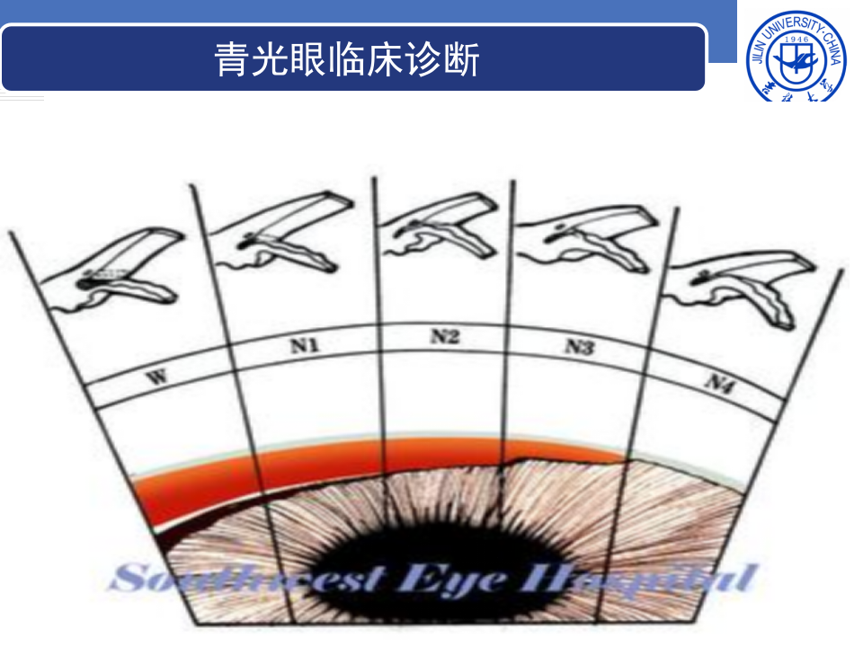 9)青光眼.ppt 第5页