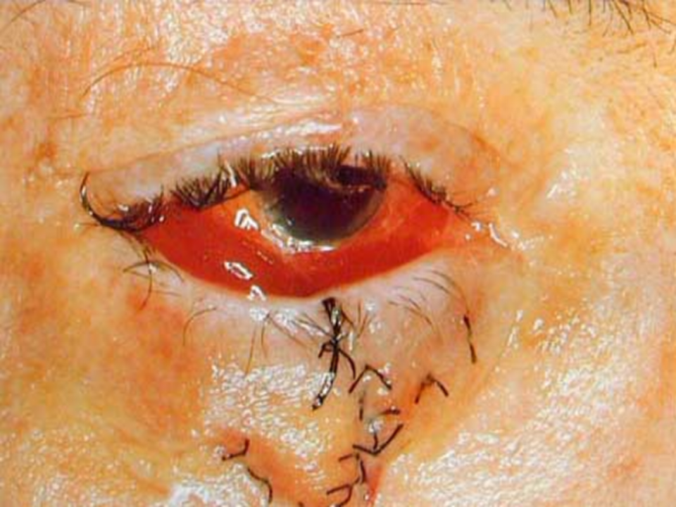 17)眼外伤第8版.ppt 第5页