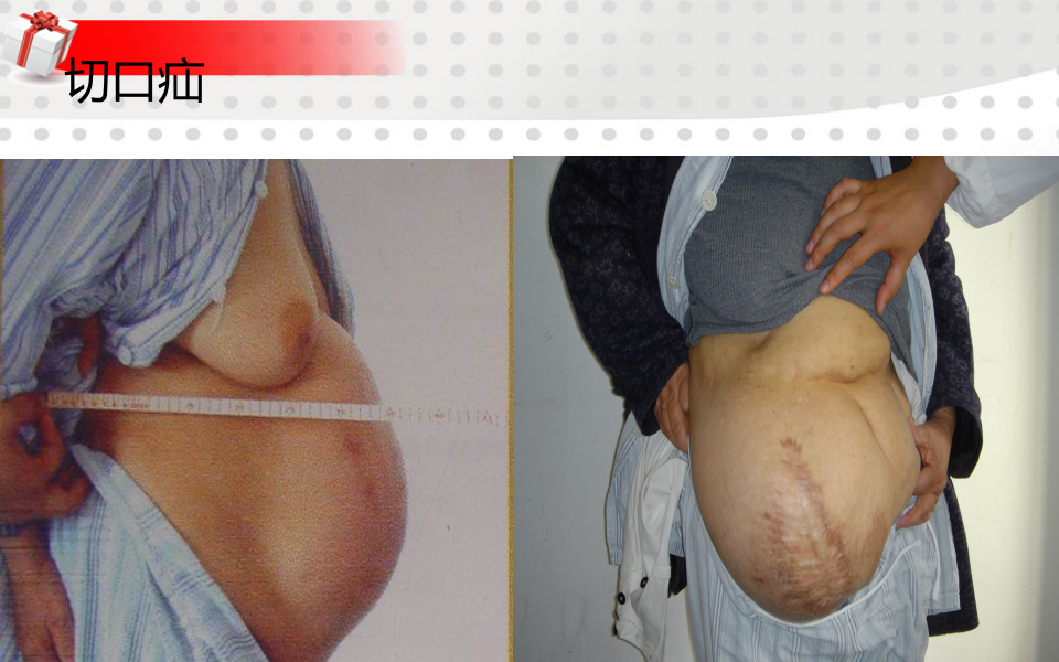 3)腹外疝-五年制课程.ppt 第4页