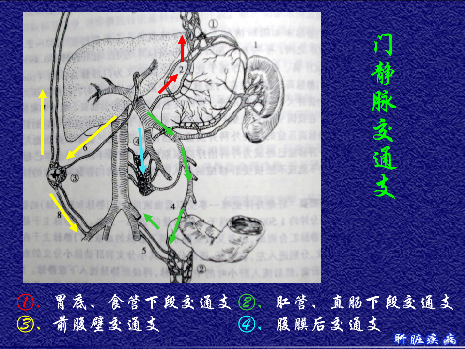 11)门脉高压症.ppt 第4页