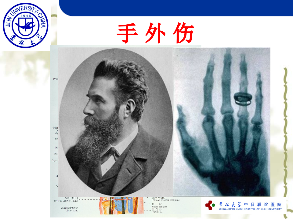 18)手外伤.ppt 第3页