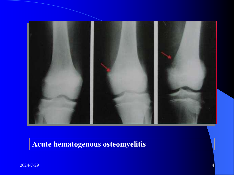 24)骨与关节感染.ppt 第4页