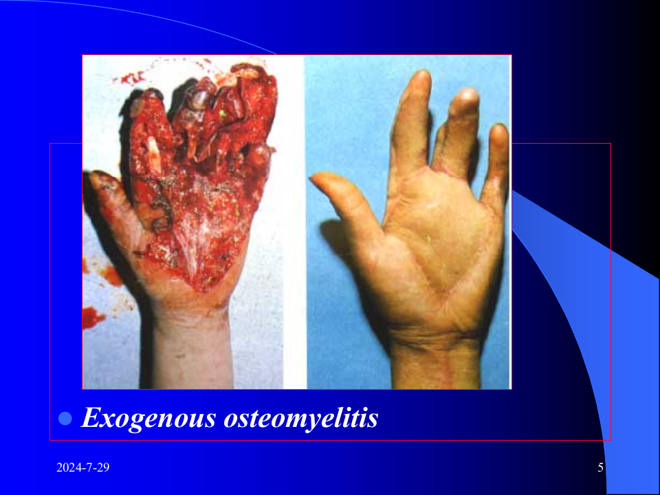 24)骨与关节感染.ppt 第5页