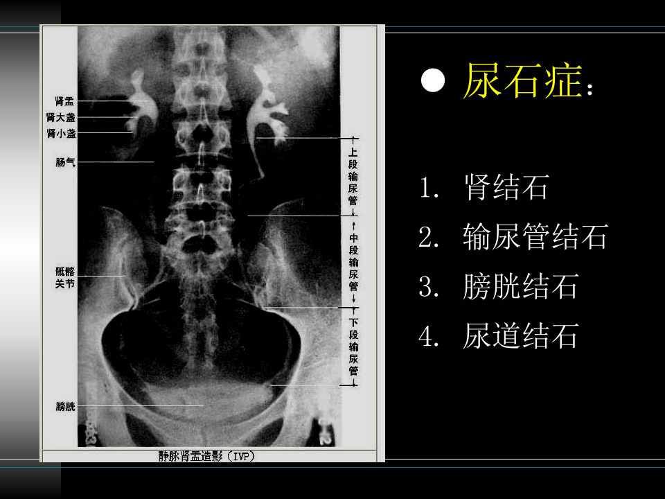 32)尿   石    症.ppt 第2页