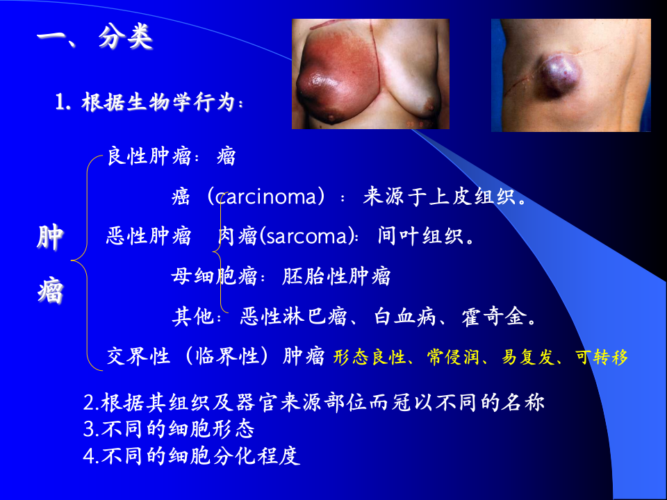 肿瘤正式!.ppt 第4页