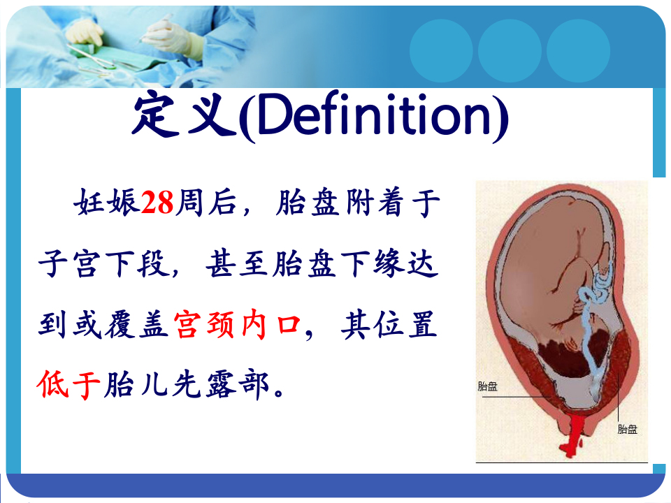 5)前置胎盘 新版.ppt 第4页