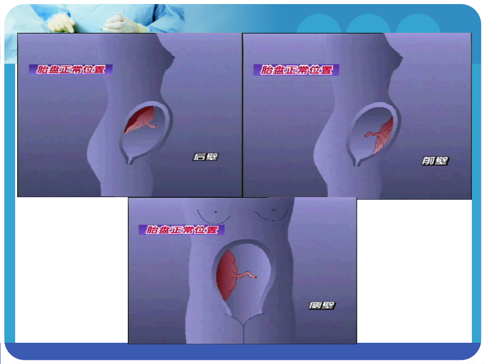 5)前置胎盘 新版.ppt 第3页