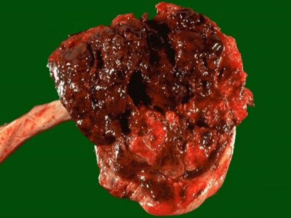 6)胎盘早剥.ppt 第4页