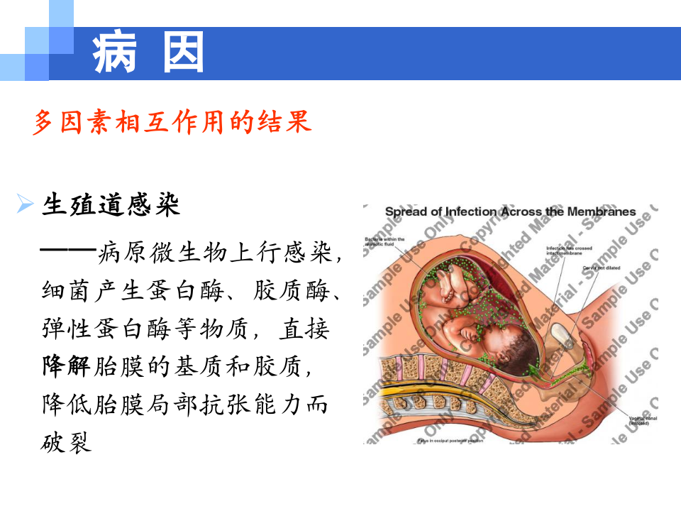 8)胎膜早破.ppt 第4页