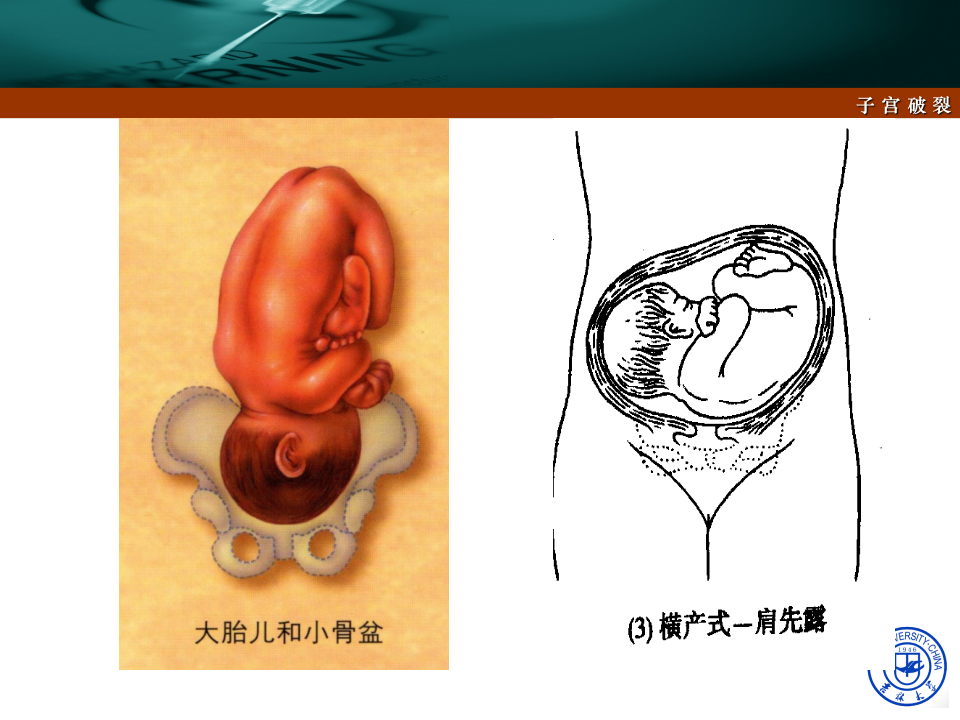 15)2015春放射子宫破裂.ppt 第4页