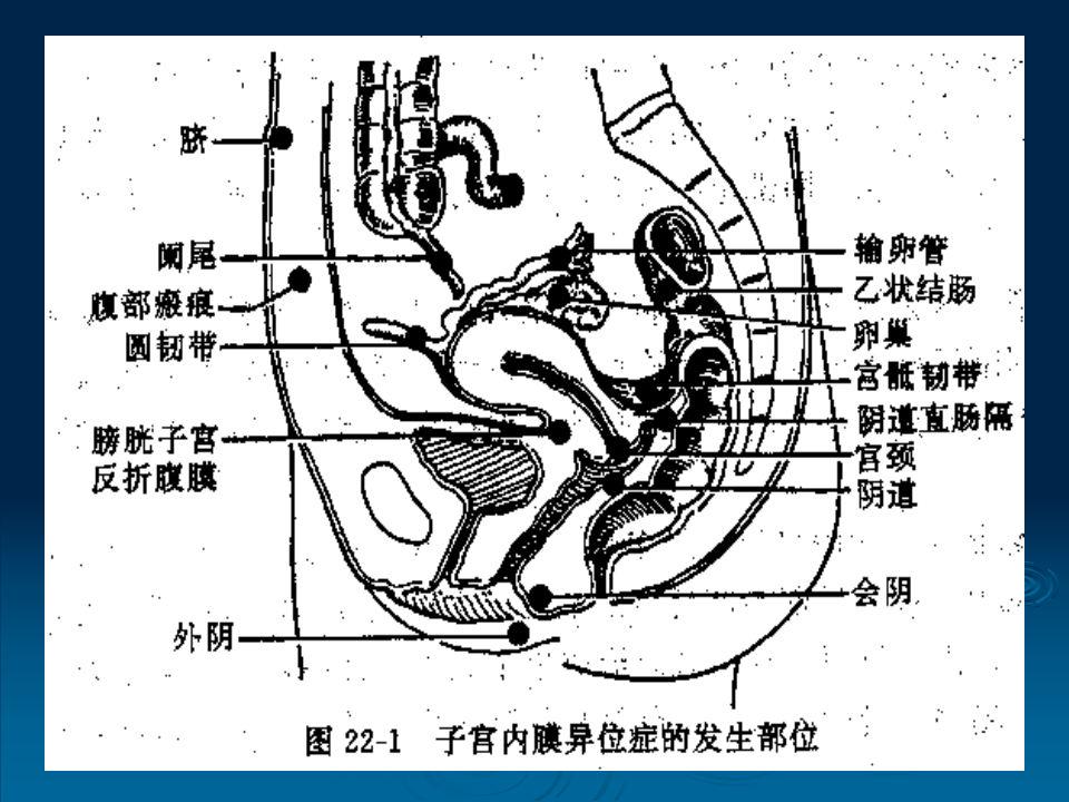 21)子宫内膜异位症.ppt 第5页