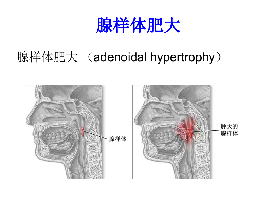 6)腺样体炎、咽及颌面脓肿、喉解剖、急慢性喉炎、声带息肉、急性会厌炎 .ppt 第2页