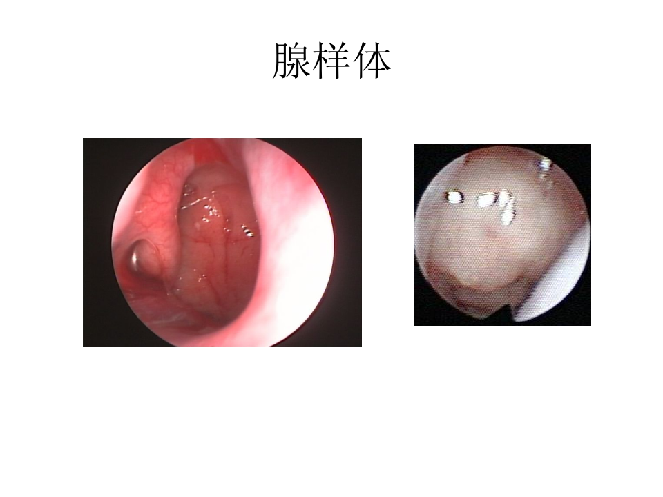 6)腺样体炎、咽及颌面脓肿、喉解剖、急慢性喉炎、声带息肉、急性会厌炎 .ppt 第3页