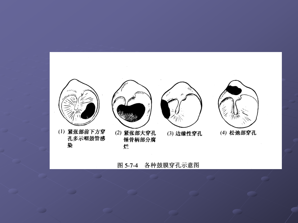 12)慢脓+并发症.ppt 第5页