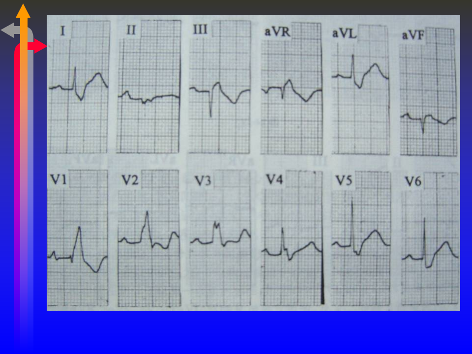 6)心电图－第六次课（心律失常三）.ppt 第4页