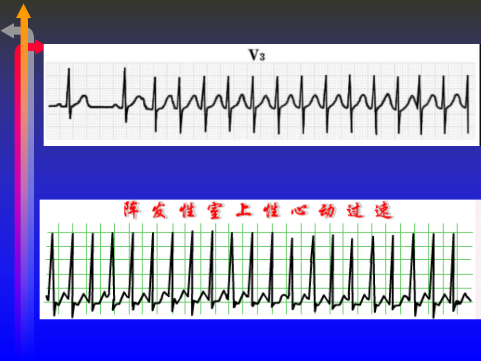 心电图－第五次课（心律失常二）.ppt 第5页