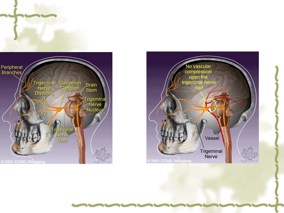三叉神经痛修改.ppt 第5页