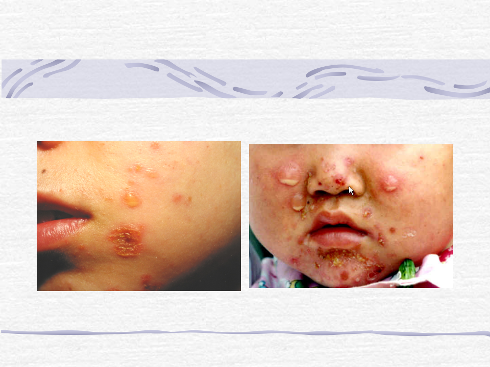 3)春季放射口腔病毒、细菌性皮肤病-新.ppt 第4页