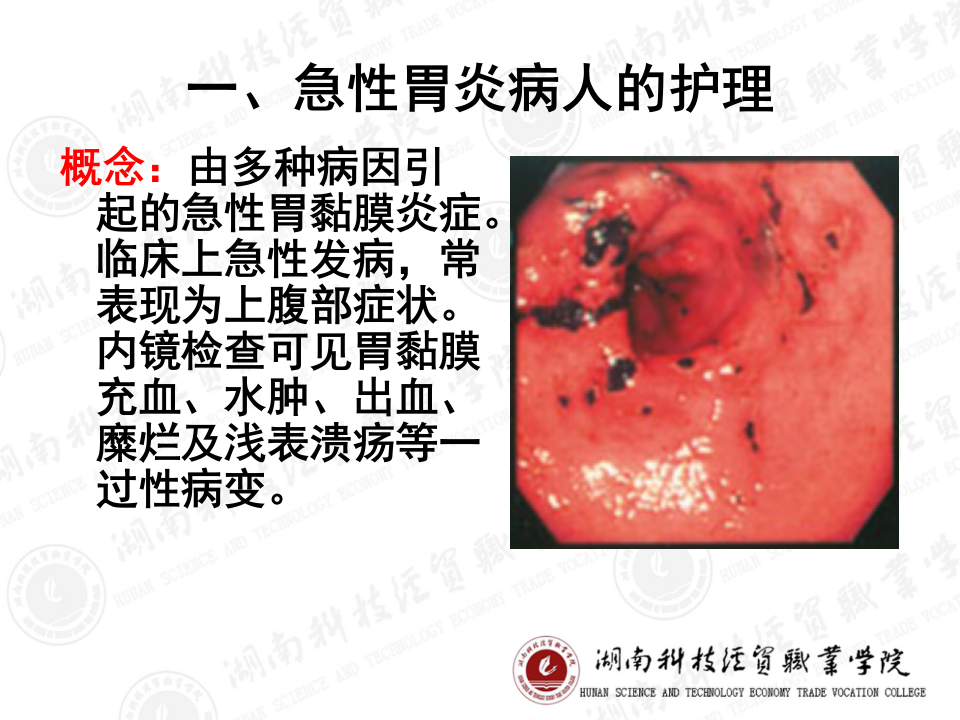 123胃炎的护理.ppt 第4页